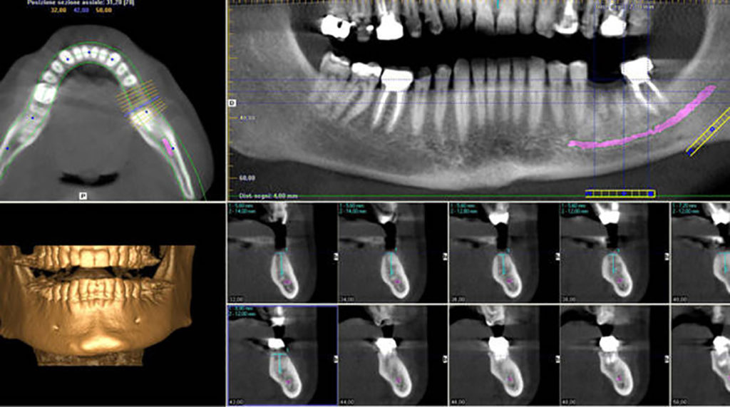 Tac Cone Beam: scopriamo cosa è e in cosa può aiutarci? – Momicchioli